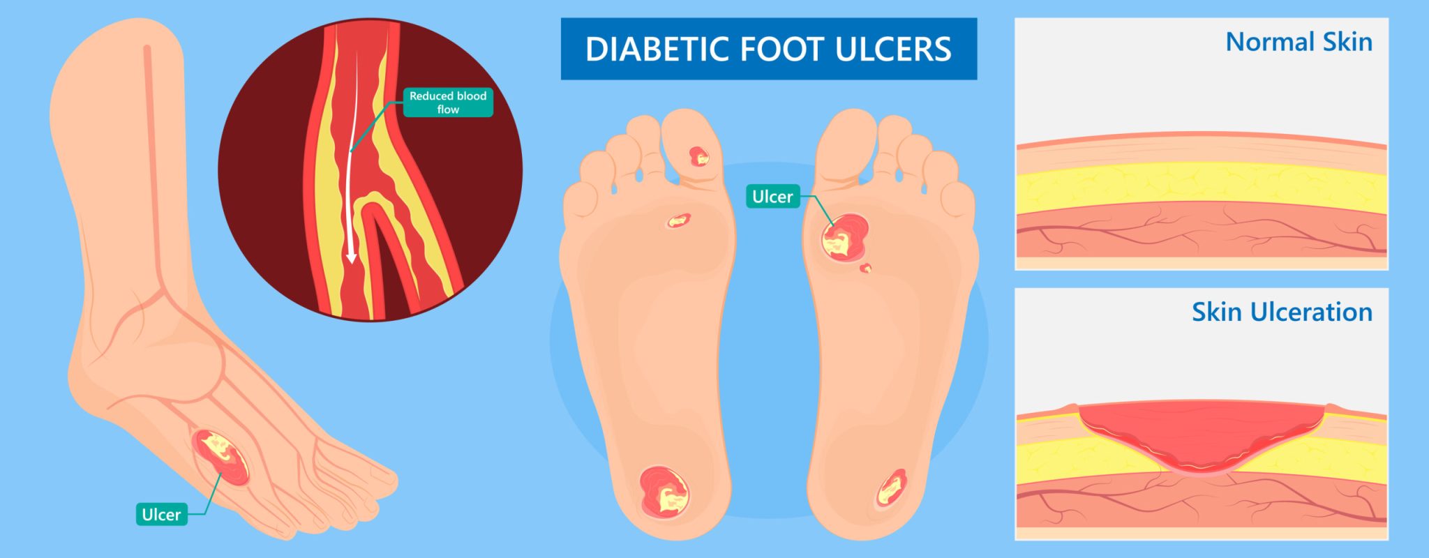 Diabetic,Foot,Ulcers,Vac,Pain,Skin,High,Feet,Sore,Heal Diabetic,Foot,Ulcers,Vac,Pain,Skin,High,Feet,Sore,Heal